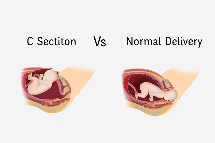 The Benefits and Risks of a Normal Delivery vs C-Section
